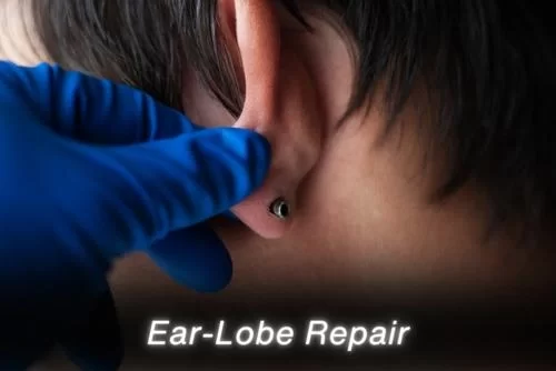 Ear-Lobe Repair