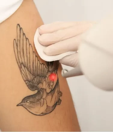 Laser-Tattoo-Removal