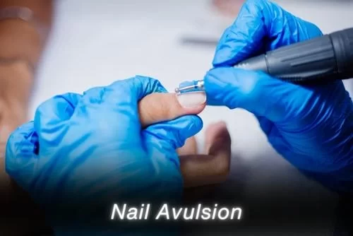 Nail Avulsion